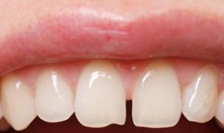 扩弓矫正牙齿的危害 扩弓矫正牙齿的危害有什么