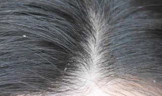 头皮去屑方法是什么 怎么去头皮屑