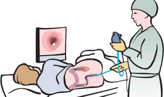 大便变细有棱角一定有问题吗 注意什么