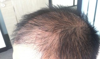 脱发能恢复吗 脱发还能不能够恢复