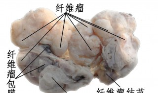乳腺管瘤是什么 什么是乳腺导管肿瘤