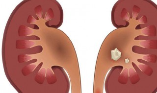 肾结石15mm算大吗 肾结石15mm严重吗
