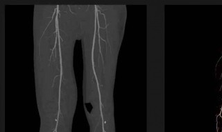 冠脉钙化危险吗 冠脉钙化要紧吗?
