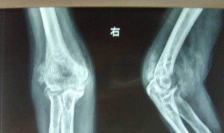 肌炎能治好吗 肌炎的症状于能否治愈