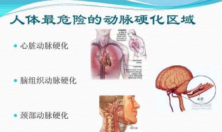 动脉硬化和动脉粥样硬化的区别 主动脉粥样硬化和动脉硬化有区别吗