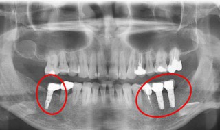 牙齿打桩是怎么回事儿 什么是牙齿打桩