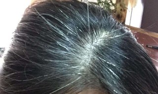 头发白发脱发严重怎么解决 有白头发还掉头发怎样治疗?