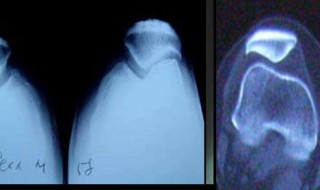 膝关节脱臼判断方法 该怎么处理
