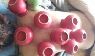 为什么下雨天不能拔罐 下雨天不能拔罐为什么