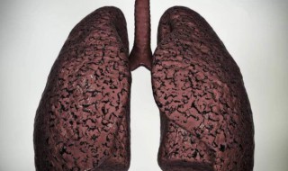 肺炎不能吃的水果 肺炎患者的禁忌