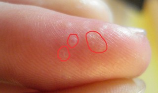 手指上有小水泡是怎么回事 手指上有小水泡解决方法