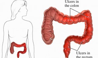 直肠癌的五大症状 直肠癌的表现