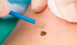 小人痣代表什么意思 小人痣的意思是什么