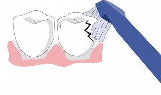 用什么方法彻底根治牙菌斑 彻底根治牙菌斑方法