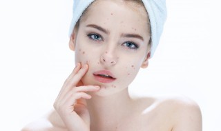 去青春痘方法 去痘痘的简单方法