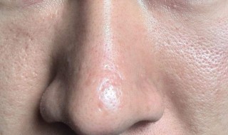 皮肤毛孔突出是怎么回事 皮肤毛孔突出什么原因