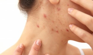 脸上太油长痘痘怎么办会怎么样 脸上特别特别油长痘怎么办