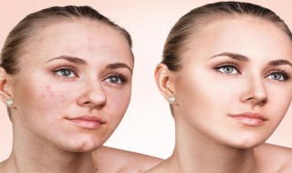 鬓角老是出痘是怎么回事（鬓角总起痘）