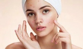 怎样保养好皮肤不长痘痘 怎样保养好皮肤不长痘痘图片