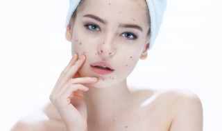 痘印痘坑怎么修复最好（痘坑修复最有效的方法）