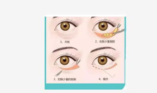 下眼袋大怎样去除 下眼袋大怎样去除效果好