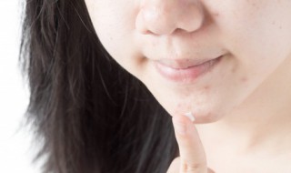 长痘痘的原因 长痘痘的原因有哪些