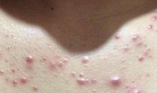 内分泌失调长痘痘 内分泌失调长痘痘图片有哪些