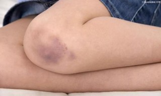 淤青怎么快速消除 眼部淤青怎么快速消除