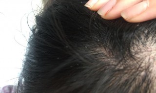 拉直头发会烫死头虱卵吗 头上长虱子了怎么办