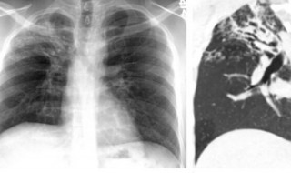 肺结核不能吃什么 肺结核不能吃什么食物要忌口