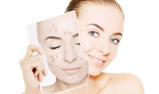 痘痘红肿怎么消除 痘痘红肿怎么消除图片