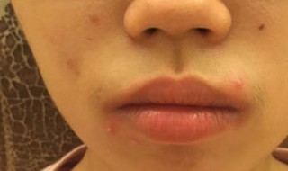 怎样去除黑头和粉刺 怎样去除黑头和粉刺闭口