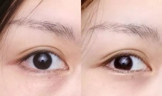 先天黑眼圈是怎么来的 先天黑眼圈和后天黑眼圈