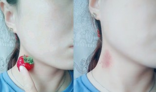 三分钟快速消除草莓印（快速消除草莓印的方法一分钟）