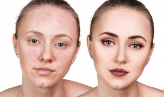 鼻子长痘是什么原因(秋季鼻子长痘是什么原因)