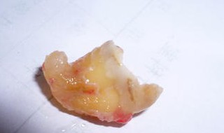 智慧牙可以自己拔掉吗（智慧牙可以自己拔掉吗图片）