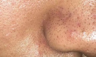 食盐可以去黑头吗 食盐可以去黑头吗?