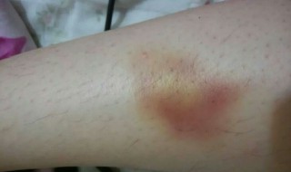 如何有效去除淤青（如何有效去除淤青小妙招）