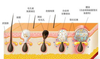 男士毛孔粗怎么办 男士毛孔粗大怎么彻底消除