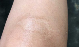 老伤疤怎么去掉（老伤疤怎么去掉运动会金牌）