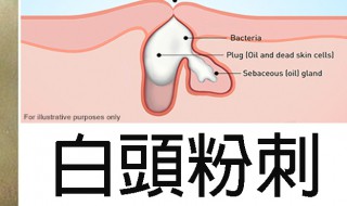 脸上长粉刺是什么原因怎样去掉 简述脸上长粉刺