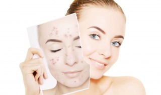 防晒霜卸不干净有危害吗 防晒霜卸不干净有危害吗图片