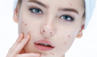 痘印留下的黑色素怎么去除 怎么去除痘印留下的黑色素