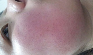 去脸部红血丝妙招(去脸部红血丝妙招有哪些)