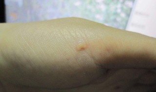 去掉瘊子的生活小妙招（去瘊子最简单最直接的方法）