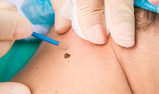 痦子怎么读 嚰怎么读