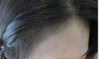 经常扎头发发际线会变高吗（雍禾种植毛发医院地址在哪里）