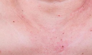 红痣的位置和命运（脸上红痣的位置和命运）