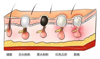 如何判断毛孔是否粗大? 怎么判断毛孔粗大