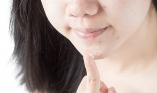 嘴巴周围长痘的原因 孕期嘴巴周围长痘的原因